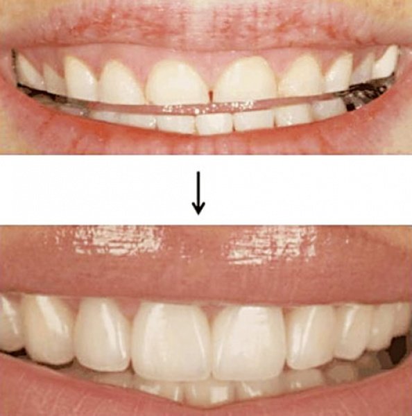 Obrabljene zobe lahko obnovimo