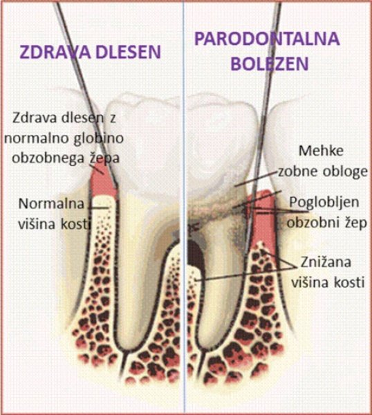Parodontalna bolezen – tihi ubijalec